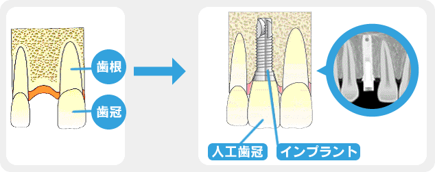 インプラント　イメージ図