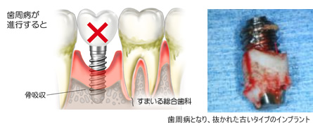 歯周病が進行すると・・・