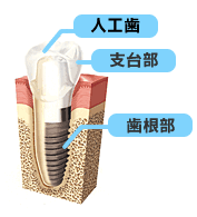 図解：「人工歯」「支台部」「歯根部」